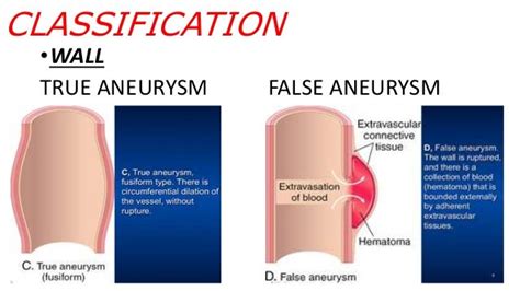 true vs false aneurysm.